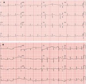 A: electrocardiogram obtained in the emergency department showing sinus rhythm at 75 bpm. Normal axis. Narrow QRS and ST-segment elevation in the inferolateral wall. Corrected QT in the normal range. B: electrocardiogram obtained 5 days later showing sinus rhythm at 85 bpm. Normal axis. Narrow QRS. Generalized ST-segment elevation with concave morphology. Corrected QT in the normal range.