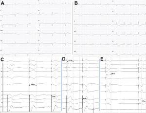 A: baseline electrocardiogram with first-degree AVB and right bundle branch block and left axis deviation. B: LBBP; typical rsr’ morphology with normal axis. C: typical “W” morphology in V1 before lead penetration of IVS. D: initial penetration of the IVS with shortening of the paced QRS interval (212ms) and of the LVAT interval (162ms). E: capture of the left bundle with rsr’ morphology in V1, narrower QRS interval (148ms) and shorter LVAT (108ms). AVB, atrioventricular block; IVS, interventricular septum; LBBP, left bundle branch pacing; LVAT, left ventricular activation time. gr1.
