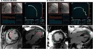 Representative case examples. Two representative case examples of ST-segment elevation myocardial infarction patients who underwent successful revascularization of the epicardial culprit vessel (LAD) during primary percutaneous coronary intervention are shown. A: the patient had an elevated angio-IMR value of 46.2, which was calculated from postpercutaneous coronary intervention angiographic images. Cardiac magnetic resonance imaging demonstrated an infarcted area (in green arrows) and evidence of MVO (in red arrows). B: the patient had an angio-IMR value of 22.3, which suggested relatively preserved microcirculatory function after ST-segment elevation myocardial infarction. Cardiac magnetic resonance imaging demonstrated an infarcted area (in green arrows) but there was no evidence of MVO. IMR, index of microcirculatory resistance; MVO, microvascular obstruction.