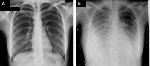 Chest radiograph: on admission (A) and 24hours later (B).