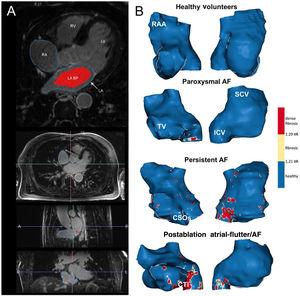 A: postprocessing of LGE-CMR images. In the upper panel, the RA and LA contours were drawn manually in an axial plane; the LA blood pool is shown in red. The 3 lower panels show axial, sagittal and coronal planes of a CMR during RA segmentation. B: anteroseptal (right) and posterolateral (left) views of representative examples of the RA in all the study groups. AF, atrial fibrillation; BP, blood pool; CSOs, coronary sinus ostium; CTI, cavo-tricuspid isthmus; ICV, inferior cava vein; LA, left atrium; LV, left ventricle; RA, right atrium; RAA, right atrium appendage; RV, right ventricle; SCV, superior cava vein; TV, tricuspid valve.