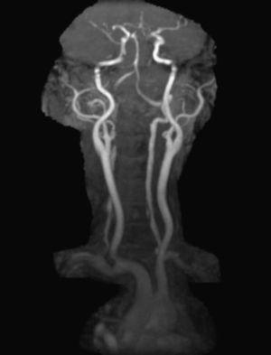 MRA of neck vessels showing dissection of bilateral vertebral arteries at multiple levels.