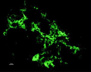 Immunofluorescència - Difusa dipòsits granulars de IGA al Mesangium.