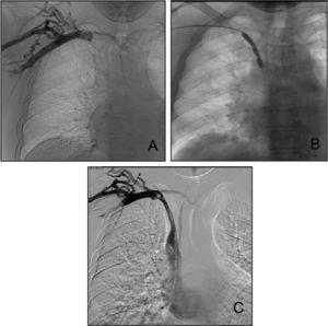 A. Flebografia d'extremitat superior dreta en la qual s'observa una oclusió de la vena subclavia a nivell de la confluència amb la vena jugular, i desenvolupament de circulació col·lateral. B. Angioplàstia de l'tronc yugulosubclavio amb catèter-baló de 8 mm de diàmetre. Després sobrepassar la zona d'oclusió i accedir a l'aurícula dreta es realitza dilatació pneumàtica de l'estenosi, durant la qual s'aprecien diverses osques en el contorn de la pilota. C. Flebografia després APT. S'observa repermeabilització de l'tronc yugulosubclavio i pas de contrast cap vena cava superior i aurícula dreta. La circulació col·lateral ha disminuït.