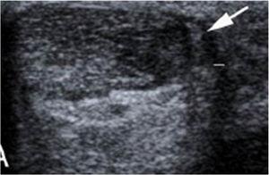 Thickened plantaris on 2D ultrasound (arrow).