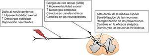 Mecanismos que participan en la patogénesis del dolor neuropático en la médula espinal. Adaptada de Navarro et al., 200716.
