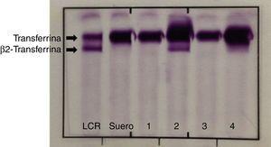 Utilidad de la β2-transferrina y la proteína β-traza en el diagnóstico ...