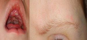 Cejas de la paciente escasamente pobladas en el tercio distal (derecha). Fisura palatina (reconstruida) y labio superior arqueado de la paciente (izquierda). Rasgos fenotípicos asociados al síndrome de Kabuki.