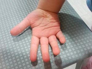 Persistencia del almohadillado en el pulpejo de los dedos de la paciente. Rasgos fenotípicos asociados al síndrome de Kabuki.