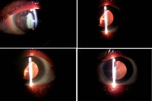 Superonasal lens coloboma, as seen in retroillumination with a slit lamp.