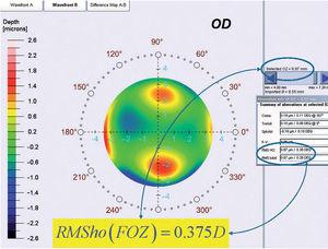 Concept of the Functional Optical Zone: By analyzing corneal Wave Aberrations for diameters starting from 4-mm, we have increased the analysis diameter in 10μm steps, until the corneal RMSho was above 0.375 D for the first time. This diameter minus 10μm was determining the FOZ.