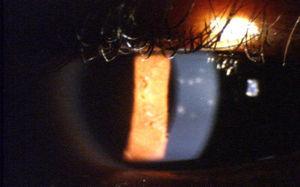 Subepithelial infiltrates associated with EKC.