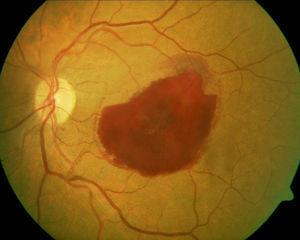Left fundus at presentation. A large preretinal hemorrhage obscures visualization of the macula. Areas of intraretinal and subretinal blood are also seen.