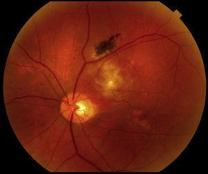 Fundus photo shows a circumscribed choroidal hemangioma superior temporal to the optic nerve in the left eye.