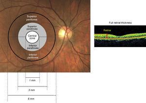 Schematic of the retinal zone assessed for full retinal thickness.