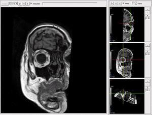 Processing images with MRI. Plane between 4 and 7mm anterior to the point where the optic nerve enters the eyeball allows the visualization and the study of the LR–SR band.