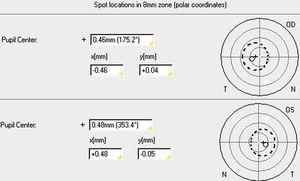 Report of pupil center in Pentacam which is the distance from the vertex normal to the pupil center in Cartesian or Polar coordinates.
