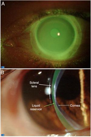 In vivo assessment of the anterior scleral contour assisted by ...