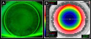 An image illustrates the fluorescein pattern with an optimal fittinig of large diameter MFGPCL (A) and a topographic map of the MFGPCL anterior surface (B).