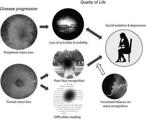 Schematic model of potential relationships between vision loss and reduced quality of life. Vision loss can reduce quality of life in a wide variety of ways, including restrictions in both physical and practical (e.g. driving a car) mobility and difficulties reading. The loss of pleasurable activities and social contact worsens depressive or anxiety symptoms. The relationship is bidirectional: depression can lead to a further withdrawal from pleasurable and/or social activities. In this review we focus on the need for blind and vision impaired individuals to rely more heavily on non‐visual information to recognize individuals and understand their emotions. The resulting difficulties in social processing may provide a causal route to social anxiety and depression.