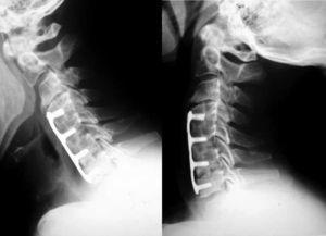 Radiografías en flexoextensión que evidencian seudoartrosis a nivel C6-7 en un paciente del grupo operado con aloinjerto tricortical de cresta ilíaca.