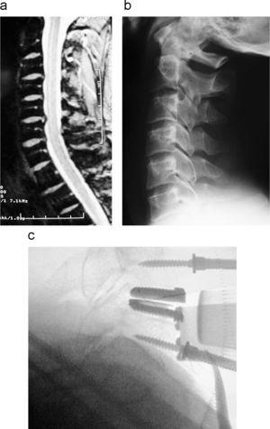 a) Hernia discal con compromiso radicular. b) En las radiografias se observan moderados cambios de espondilosis. c) Colocación de la prótesis de disco.