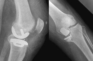Radiografías de la fractura periprotésica con hundimiento medial.