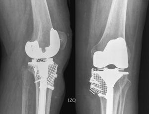 Radiografías de la prótesis total de rodilla de revisión con la malla y el vástago tibial.