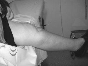 Imagen lateral de la rodilla en extensión a los 9 meses postoperatorios.