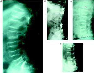 Imágenes radiográficas de raquis lumbar de una niña con ostegénesis imperfecta y múltiples acuñamientos vertebrales donde se observa la recuperación de la morfología y altura de los cuerpos vertebrales tras el tratamiento con bifosfonatos.