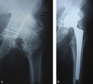 Varón de 63 años de edad. A) Radiografía anteroposterior de cadera. Coxartrosis a los 3 años tras reducción abierta y síntesis de fractura de pared y columna posterior de cotilo. Osificaciones heterotópicas grado III. B). Radiografía anteroposterior de cadera 6 años de seguimiento tras prótesis total de cadera no cementada. Osificaciones heterotópicas grado III. Resultado regular.