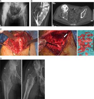 Imágenes correspondientes al caso 2. A) Radiografía de cadera derecha a los 12 meses del ACV. B) TC que muestra la osificación que afecta al psoas, vasto intermedio y medial. C) Imágenes de la intervención (de izquierda a derecha): exposición de la osificación a través de un abordaje de Smith-Petersen; tras resecar gran parte de la lesión se aprecia la proximidad de la arteria femoral profunda (flecha) y cómo se llegó hasta el plano de la cápsula articular (sujetada por pinza de disección); fragmentos óseos extraídos. D) Radiografías anteroposterior y axial a los 12 meses de la cirugía.