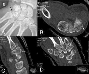 A) Radiografía inicial con fractura aislada del cuerpo del ganchoso. B, C y D) Control TC de la fractura a la semana.