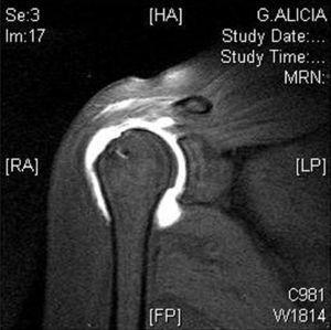 Corte coronal de artro-RM de hombro que muestra fuga de contraste sugerente de franca rerotura del manguito rotador.