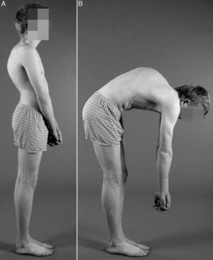 Fotografías clínicas lateral de pie (A), y lateral en flexión lumbar (B), de un paciente varón con enfermedad de Scheuermann, que demuestran la presencia de una cifosis torácica grave, que produce una gibosidad angular.