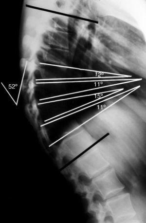 Radiografía lateral simple de un paciente adolescente con enfermedad de Scheuermann con una cifosis torácica de 52°. La medida del grado de acuñamiento segmentario se obtiene del ángulo de intersección de las tangentes sobre los platillos superior e inferior de cada cuerpo vertebral. El criterio diagnóstico establece un acuñamiento superior a los 5° en al menos 3 vertebras consecutivas en el ápex de la cifosis.