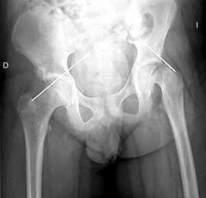 Radiografía A-P de pelvis. Línea de Klein lateral a la epífisis en la cadera izquierda.
