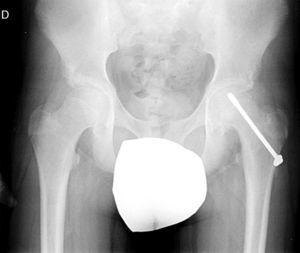 Radiografía A-P de pelvis de un paciente de 13 años. Epifisiolisis estable tratada mediante un tornillo de rosca parcial.