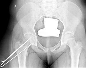 Radiografía A-P de pelvis de una paciente de 11 años tratada mediante múltiples agujas de Kirschner.