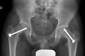 Radiografía A-P de pelvis de un paciente de 14 años con epifisiolisis bilateral tratado con tornillos de rosca parcial.