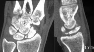 TC, cortes coronal y sagital, que confirma la fragmentación del polo proximal del escafoides, sin signos de consolidación ósea.