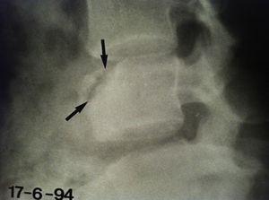 Radiografía lumbar a nivel de L3 donde se aprecia la imagen de «seudoartrosis» vertebral en la paciente con historia de traumatismo previo.