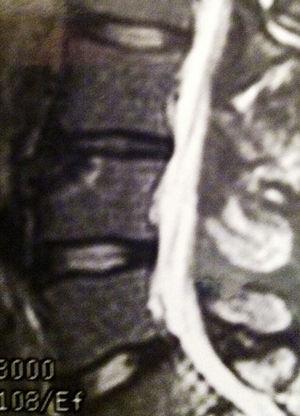 Imagen de IRM de limbus vertebral en el caso del varón con afectación de la L3.