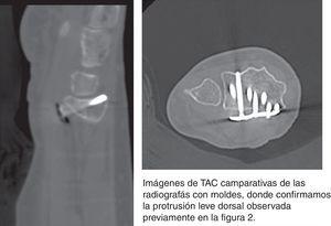 Imágenes de la TAC comparativas de las Rx con moldes, donde confirmamos la protrusión leve dorsal observada previamente en la figura 2.