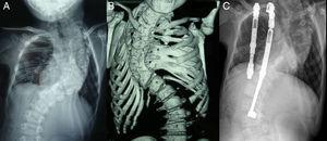 A) Radiografía PA de un niño de 6+9 diagnosticado de escoliosis congénita en el contexto de una asociación VATER que presenta una curva torácica derecha de 96°. B) TAC de reconstrucción tridimensional en la que se aprecian las múltiples anomalías vertebrales y las fusiones costales. C) Radiografía actual. El paciente tiene 9+5 y tras 5 intervenciones la curva presenta 97°.
