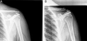 A) Radiografía de control posquirúrgico en la cual se aprecia una buena reducción de las fracturas. B) Radiografía de seguimiento en la que se aprecia la consolidación satisfactoria de las fracturas.