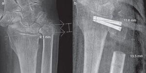 Radiografía AP de muñeca preoperatoria con mediciones de varianza cubital (a) y postoperatoria con mediciones de nivel y longitud de la osteotomía (b).