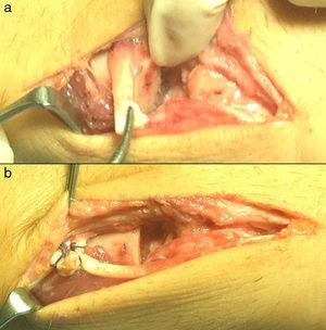 Plastia de interposición con hemitendón del extensor carpi ulnaris a modo de corbata o bufanda sobre el muñón proximal del cúbito (a) y sutura del hemitendón sobre sí mismo (b).