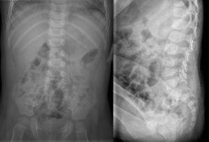 Radiografías simples, proyecciones anteroposterior y lateral de un paciente de 14 meses con una discitis L4-L5, realizadas 4 semanas después del inicio de los síntomas.
