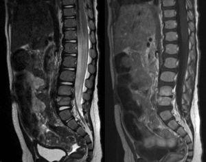 Cortes de RNM adquisición en T1 (derecha) y T2 (izquierda) de un paciente de 14 meses con una discitis L4-L5 (mismo paciente que el de la figura 2).
